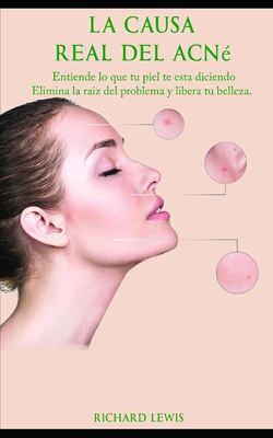 La Causa Real Del Acne: Entiende lo que tu piel... [Spanish] B08FKPGVVB Book Cover