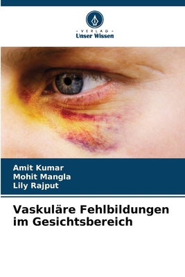 Vaskuläre Fehlbildungen im Gesichtsbereich [German] 6207434501 Book Cover