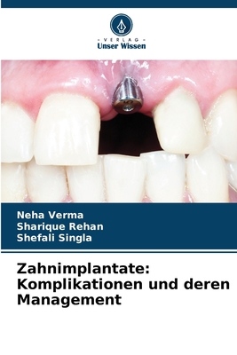 Zahnimplantate: Komplikationen und deren Manage... [German] 620576024X Book Cover