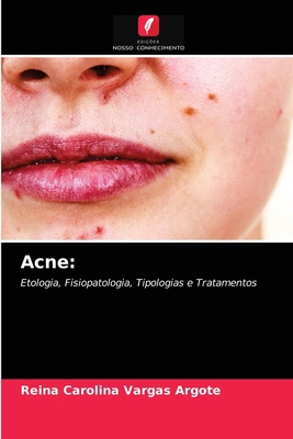 Acne [Portuguese] 6203482609 Book Cover