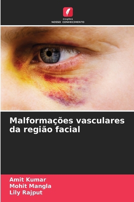 Malformações vasculares da região facial [Portuguese] 6207434544 Book Cover