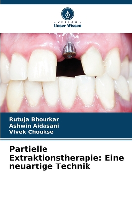 Partielle Extraktionstherapie: Eine neuartige T... [German] 6207972422 Book Cover