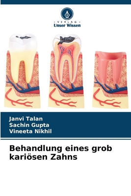 Behandlung eines grob kariösen Zahns [German] 6207766784 Book Cover