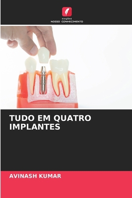 Tudo Em Quatro Implantes [Portuguese] 6208300428 Book Cover