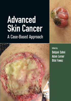 Advanced Skin Cancer: A Case-Based Approach 0367134713 Book Cover