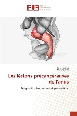 Les lésions précancéreuses de l'anus [French] 6139615070 Book Cover