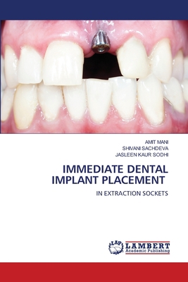 Immediate Dental Implant Placement 6203202843 Book Cover