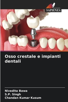 Paperback Osso crestale e impianti dentali [Italian] Book