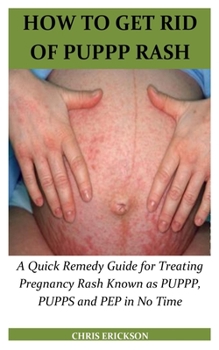 Paperback How to Get Rid of Puppp Rash: A Quick Remedy Guide for Treating Pregnancy Rash Known as PUPPP, PUPPS and PEP in No Time Book