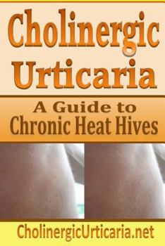 Paperback Cholinergic Urticaria: A Guide to Chronic Heat Hives Book