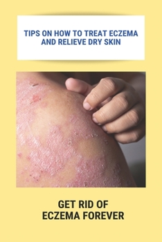 Paperback Tips On How To Treat Eczema And Relieve Dry Skin: Get Rid Of Eczema Forever: Overcome Eczema Book