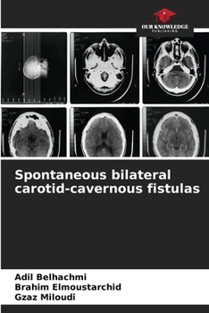 Paperback Spontaneous bilateral carotid-cavernous fistulas Book