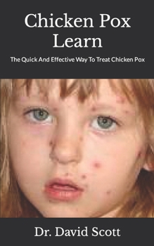 Paperback Chicken Pox Learn: The Quick And Effective Way To Treat Chicken Pox Book