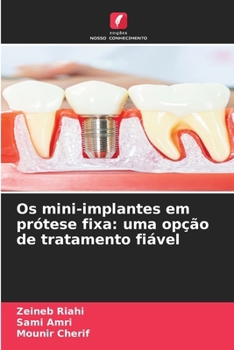 Paperback Os mini-implantes em prótese fixa: uma opção de tratamento fiável [Portuguese] Book