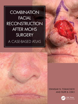 Hardcover Combination Facial Reconstruction After Mohs Surgery: A Case Based Atlas Book
