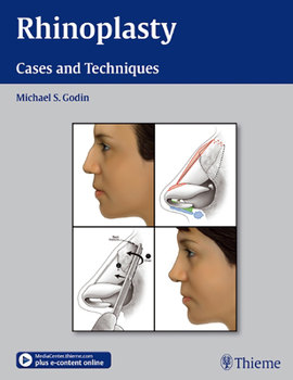 Hardcover Rhinoplasty: Cases and Techniques Book