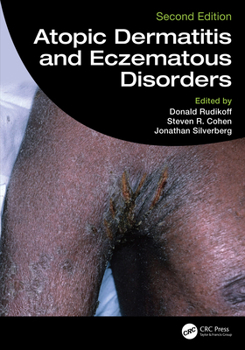 Hardcover Atopic Dermatitis and Eczematous Disorders Book