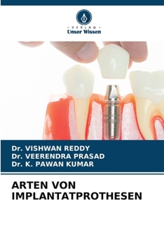 Arten Von Implantatprothesen (German Edition)