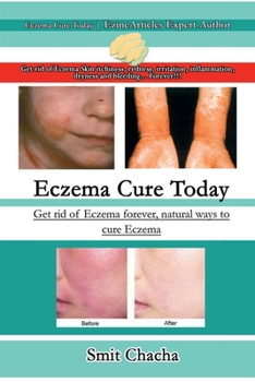 Paperback Eczema Cure Today - Get rid of Eczema forever natural ways to cure Eczema Book