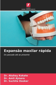 Expansão maxilar rápida (Portuguese Edition)