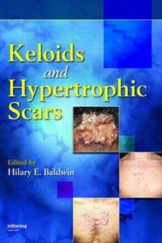 Hardcover Keloids and Hypertrophic Scars (Basic and Clinical Dermatology) Book
