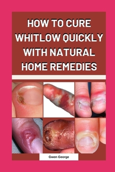 Paperback How to Cure Whitlow Quickly with Natural Home Remedies Book