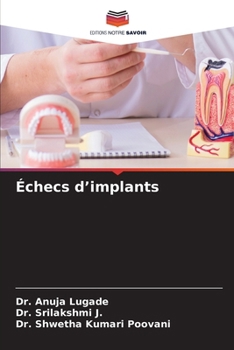 Paperback Échecs d'implants [French] Book