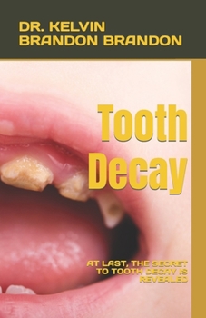 Tooth Decay: At Last, the Secret to Tooth Decay Is Revealed