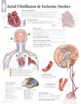 Wall Chart Atrial Fib & Ischemic Strokes Wall Chart Book