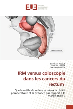 IRM versus coloscopie dans les cancers du rectum (French Edition)