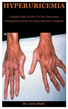 Hyperuricemia: A Simple Guide On How To Cure, Prevention, Management And Reverse Hyperuricemia Completely