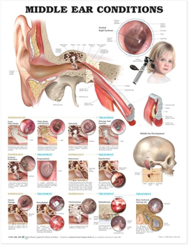 Wall Chart Middle Ear Conditions Anatomical Chart Book