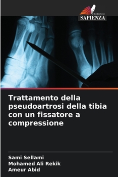 Paperback Trattamento della pseudoartrosi della tibia con un fissatore a compressione [Italian] Book