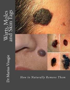 Paperback Warts, Moles and Skin Tags: How to Naturally Remove Them Book