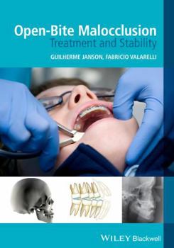 Paperback Open-Bite Malocclusion: Treatment and Stability Book
