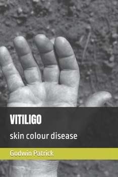 Paperback Vitiligo: skin colour disease Book