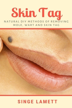 Paperback Skin Tag: Natural DIY Methods of removing Mole, Wart and Skin Tag Book