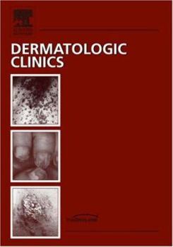 Hardcover Update on HIV/AIDS, An Issue of Dermatologic Clinics (Volume 24-4) (The Clinics: Dermatology, Volume 24-4) Book