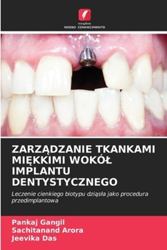 ZarzAdzanie Tkankami MiEkkimi Wokól Implantu Dentystycznego (Polish Edition)