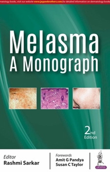Paperback Melasma: A Monograph Book