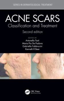 Hardcover Acne Scars: Classification and Treatment, Second Edition Book