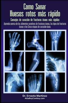 Paperback Como curar huesos rotos más rápido. Consejos para curar fracturas de huesos: Aprenda sobre los alimentos para la curación de fracturas, los tipos de f [Spanish] Book