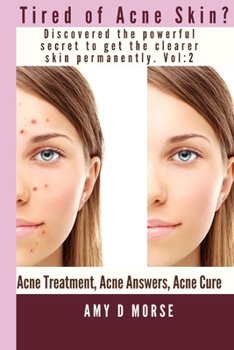 TIRED OF ACNE SKIN? Discover the Powerful Secrets to get Clearer Skin Permanently