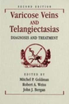 Hardcover Varicose Veins and Telangiectasias: Diagnosis and Treatment Book