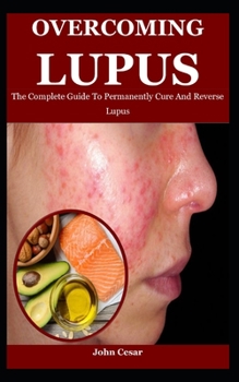 Paperback Overcoming Lupus: The Complete Guide To Permanently Cure And Reverse Lupus Book