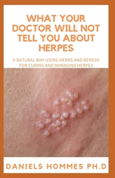 Paperback What Your Doctor Will Not Tell You about Herpes: A Natural Easy herbal and Home Remedies to Get Rid Of Herpes Book