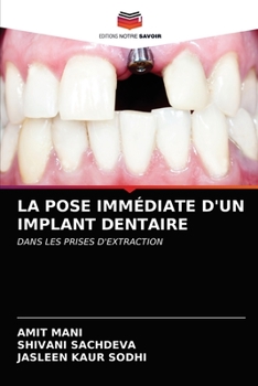 Paperback La Pose Immédiate d'Un Implant Dentaire [French] Book