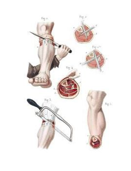 Paperback Amputation of the Leg Composition Notebook: Wide Ruled Note-Taking Book
