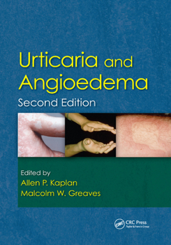 Paperback Urticaria and Angioedema Book