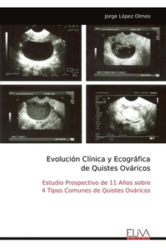 Evolución Clínica y Ecográfica de Quistes Ováricos: Estudio Prospectivo de 11 Años sobre 4 Tipos Comunes de Quistes Ováricos (Spanish Edition)